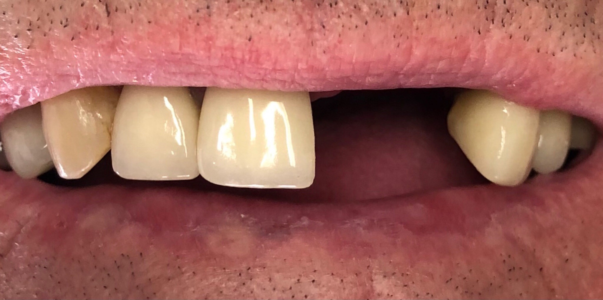 Before: dental implants replacing four missing front teeth, Soquel Dental Office in Soquel, CA