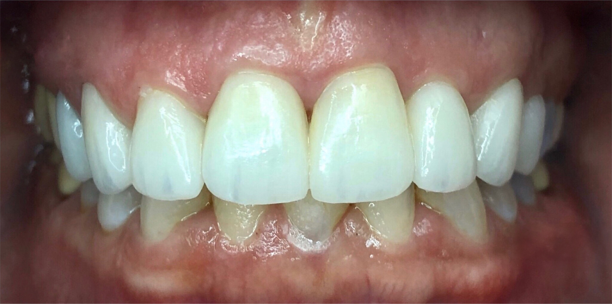 After: Empress veneers placed in a single day, Soquel Dental Office in Soquel, CA