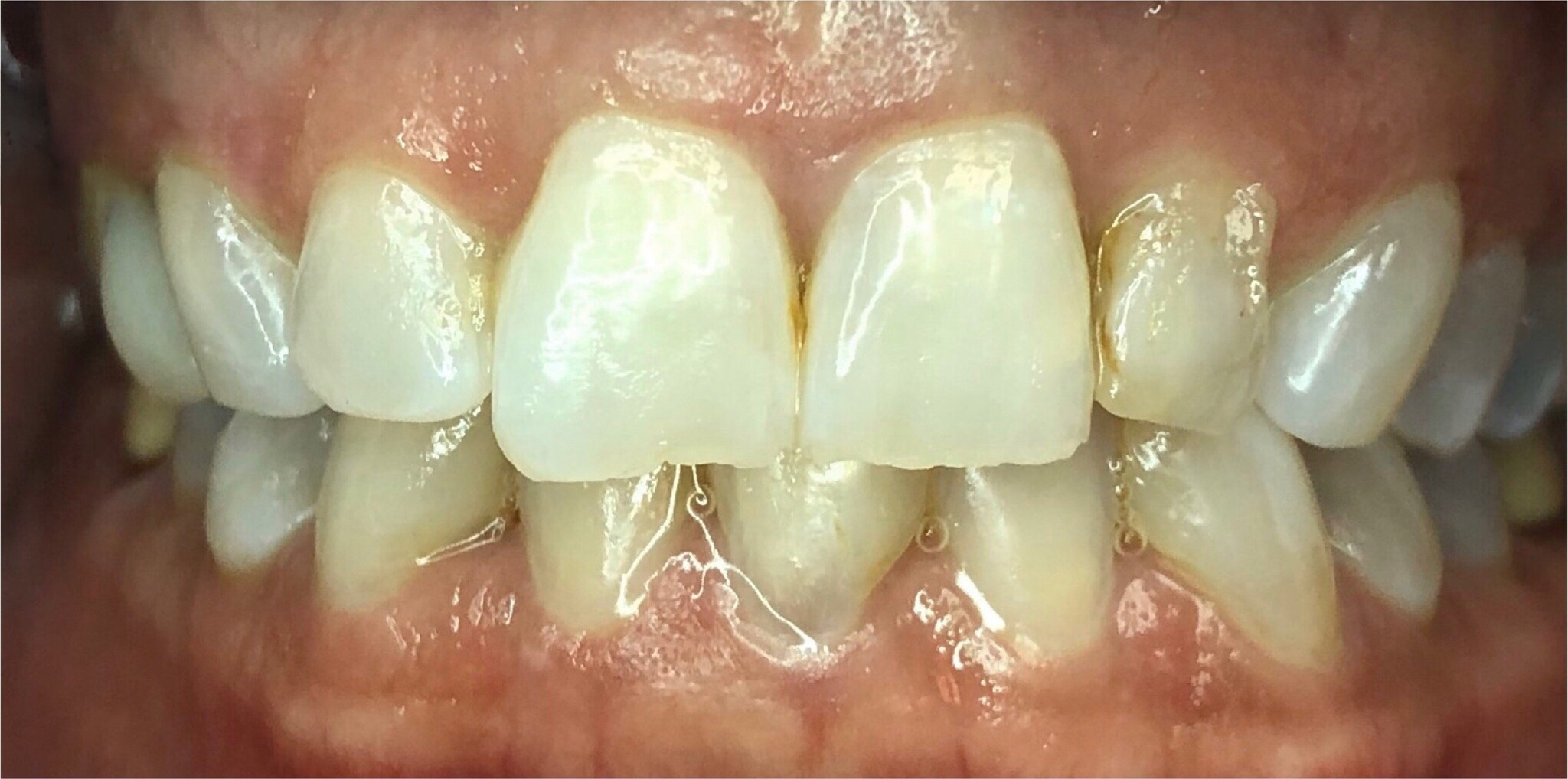 Before: Empress veneers placed in a single day, Soquel Dental Office in Soquel, CA