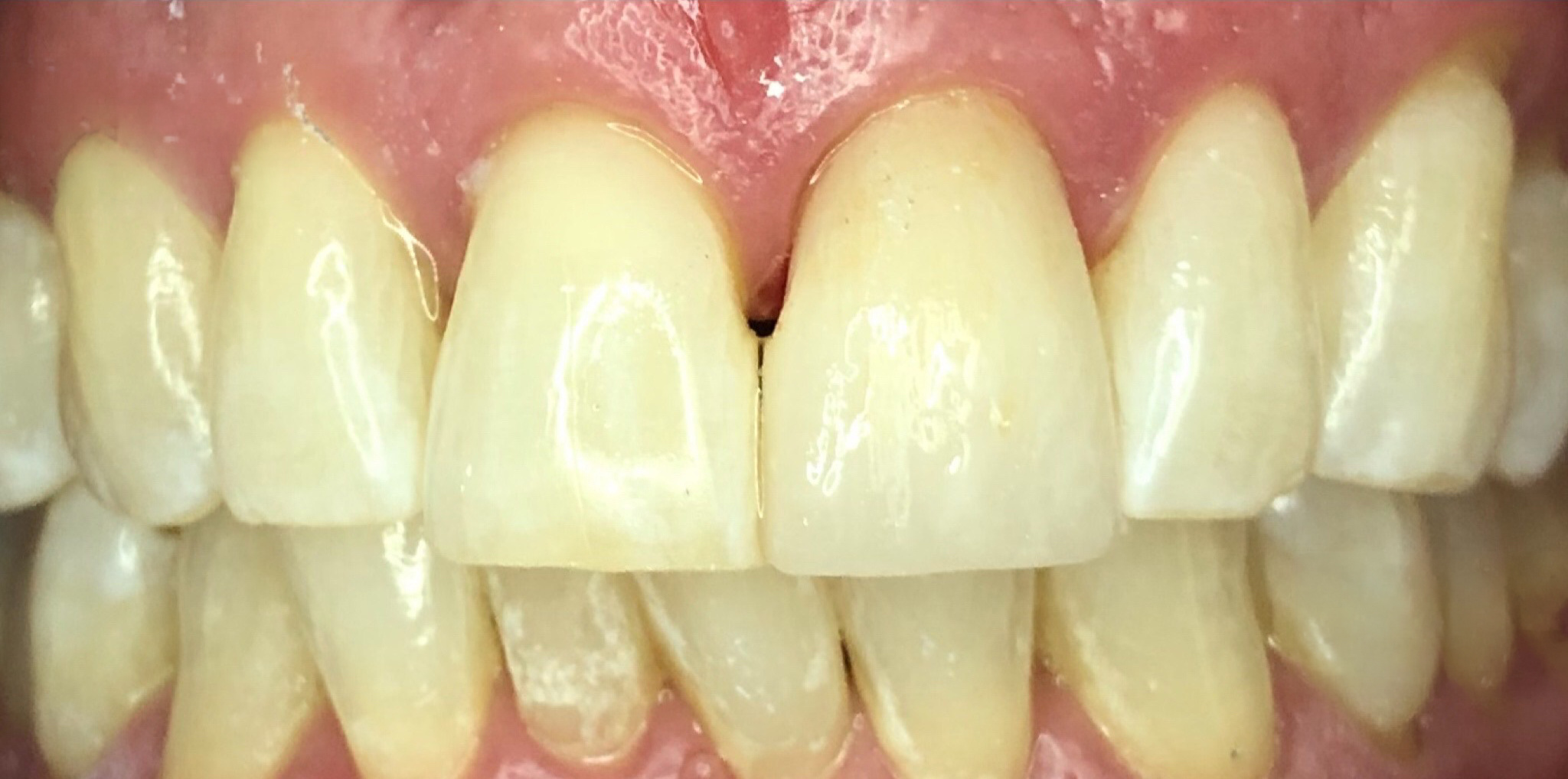 After: a worn crown replaced with an all-porcelain crown, Soquel Dental Office in Soquel, CA