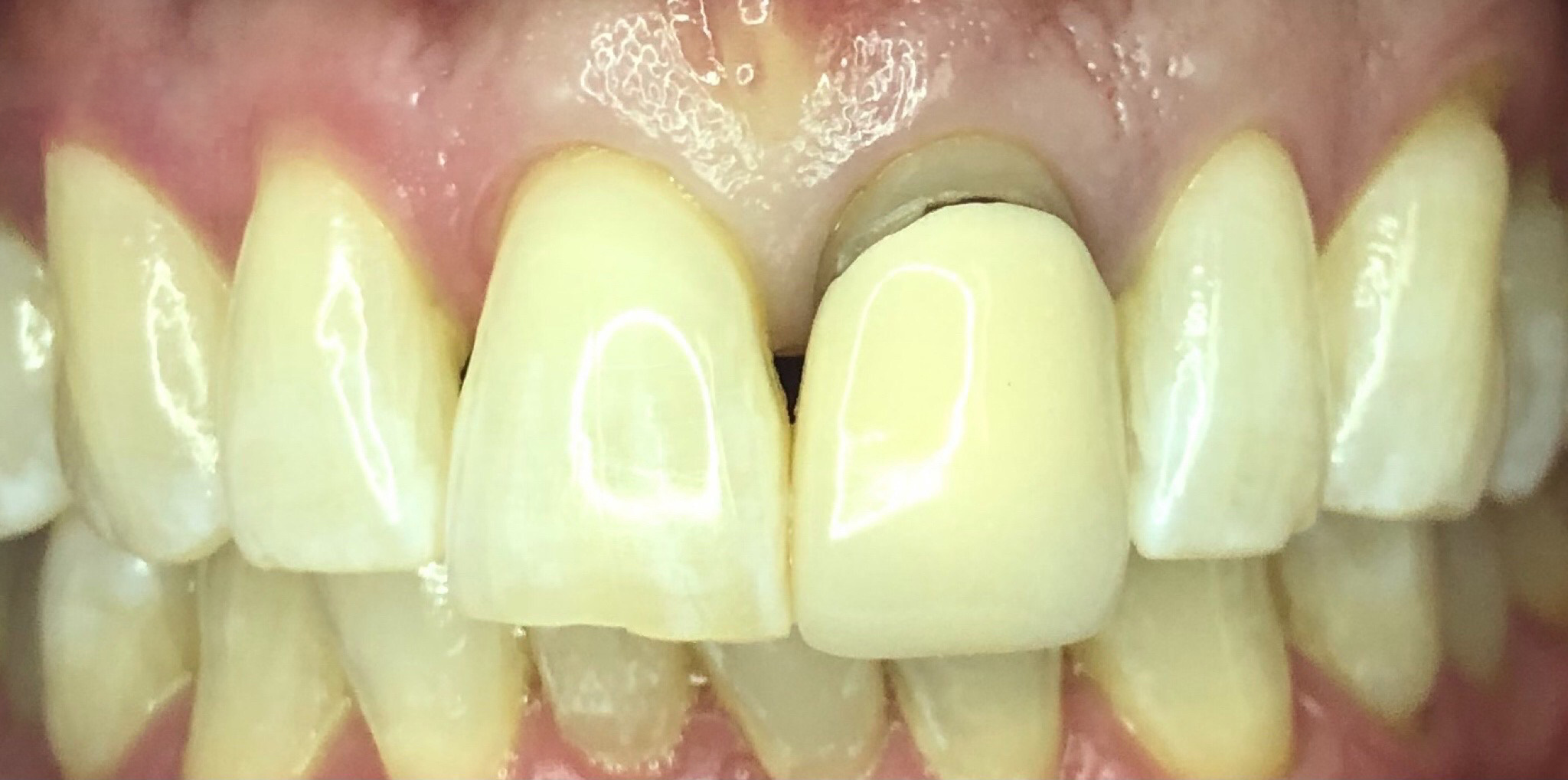 Before: a worn crown replaced with an all-porcelain crown, Soquel Dental Office in Soquel, CA
