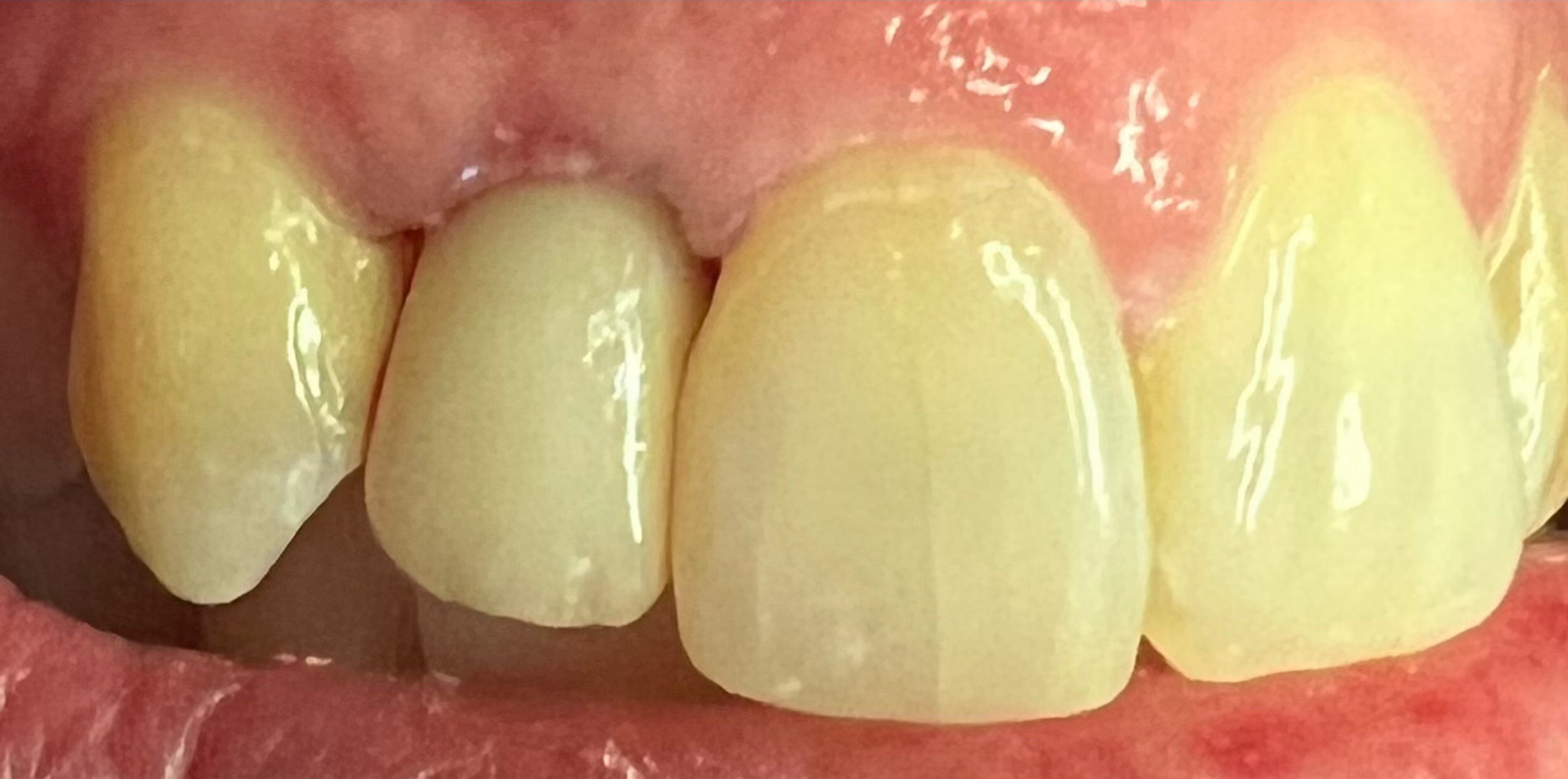 After: a root canal and same-day crown saving a tooth headed for extraction, Soquel Dental Office in Soquel, CA
