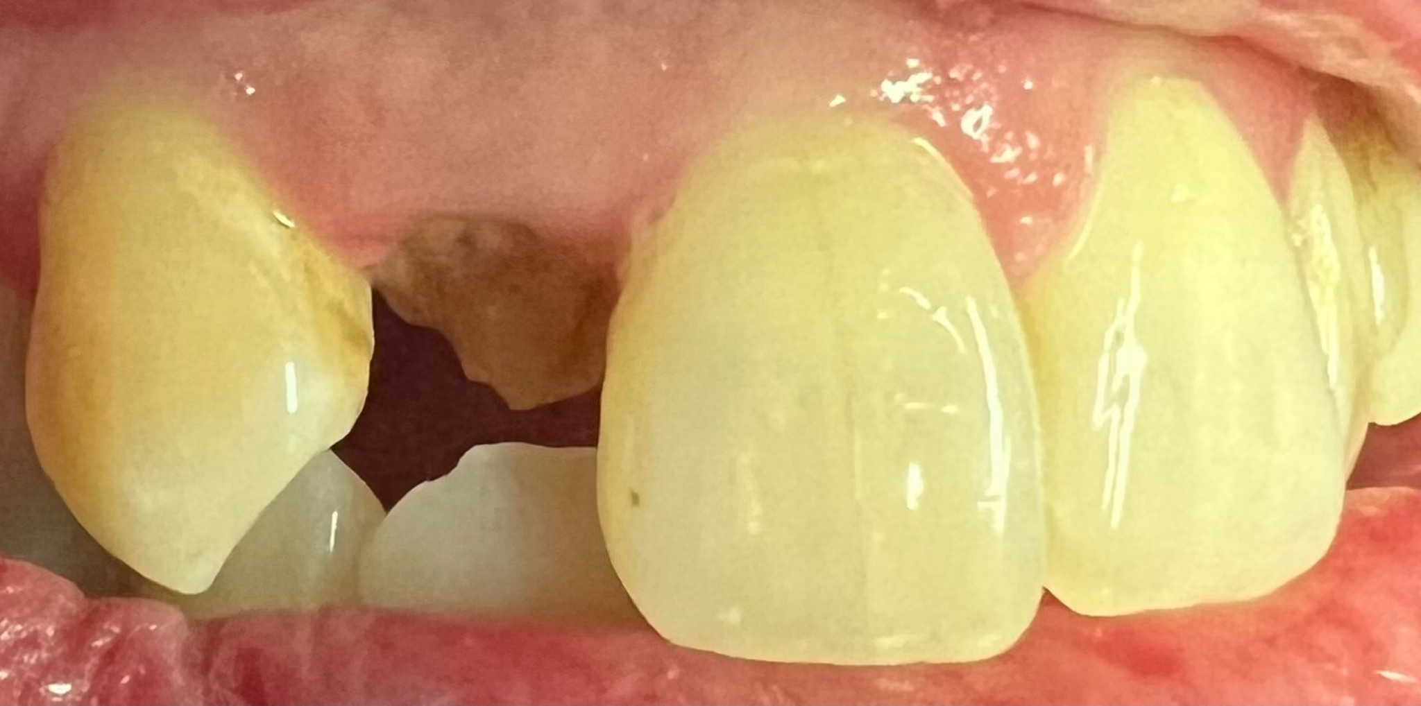 Before: a root canal and same-day crown saving a tooth headed for extraction, Soquel Dental Office in Soquel, CA