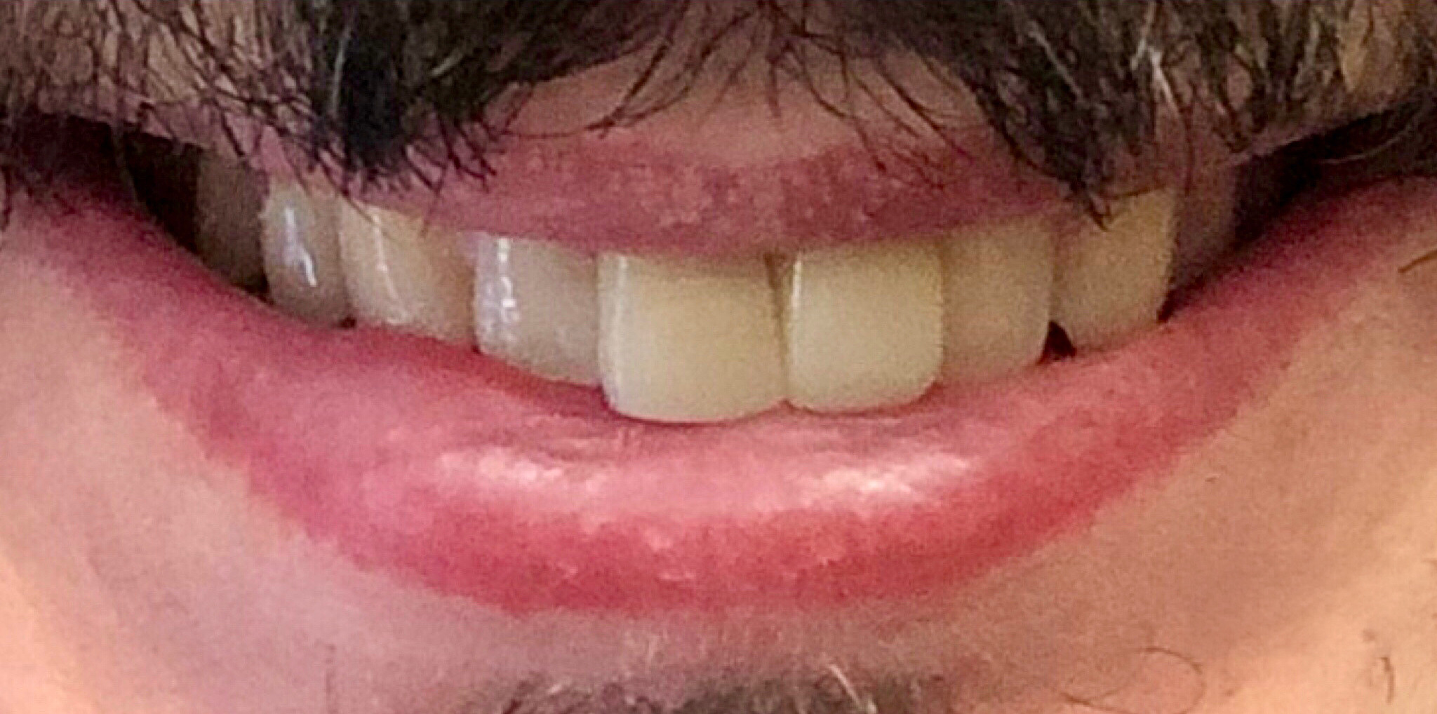 After: a single dental implant replacing a missing front tooth, Soquel Dental Office in Soquel, CA