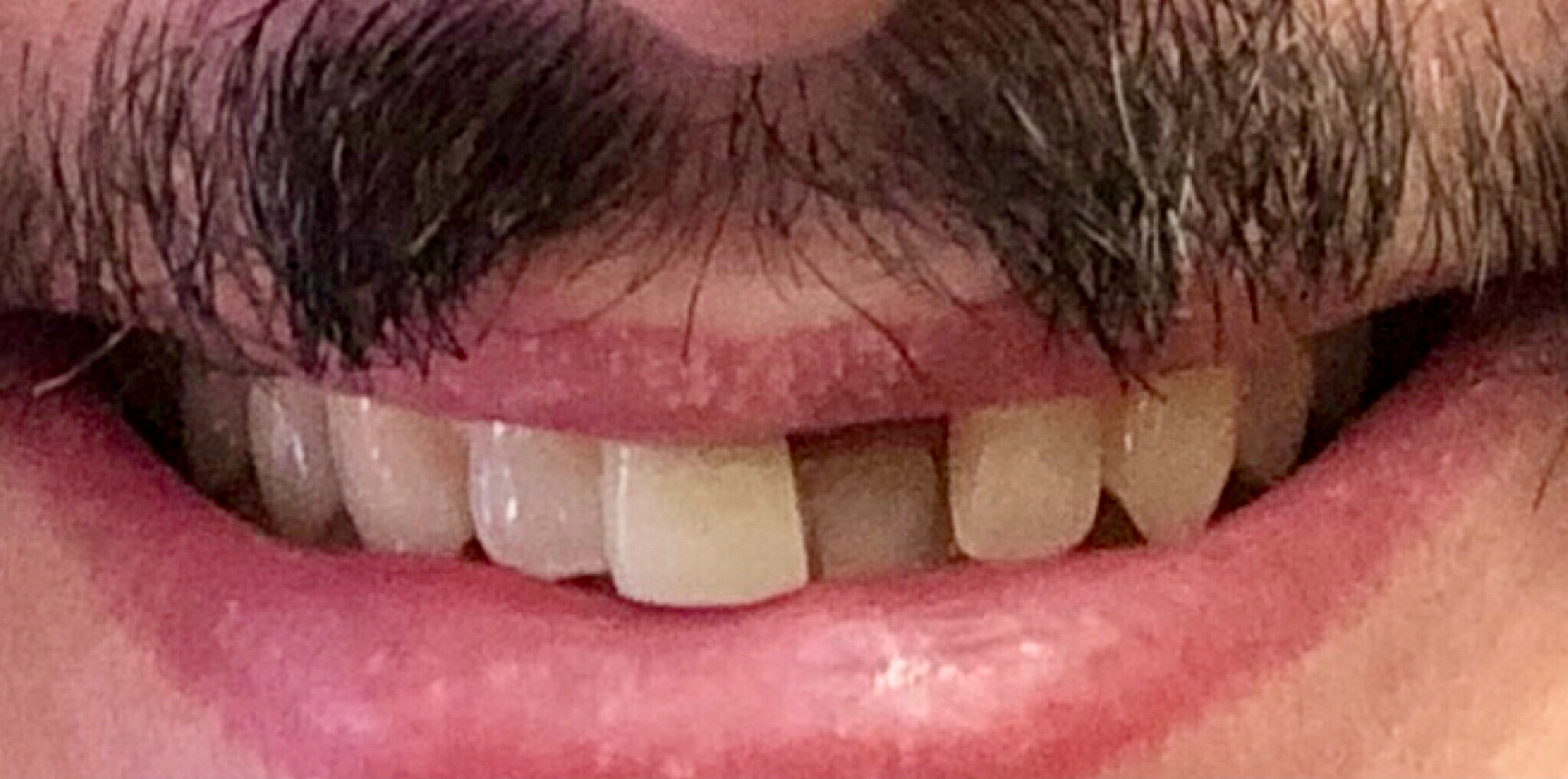 Before: a single dental implant replacing a missing front tooth, Soquel Dental Office in Soquel, CA