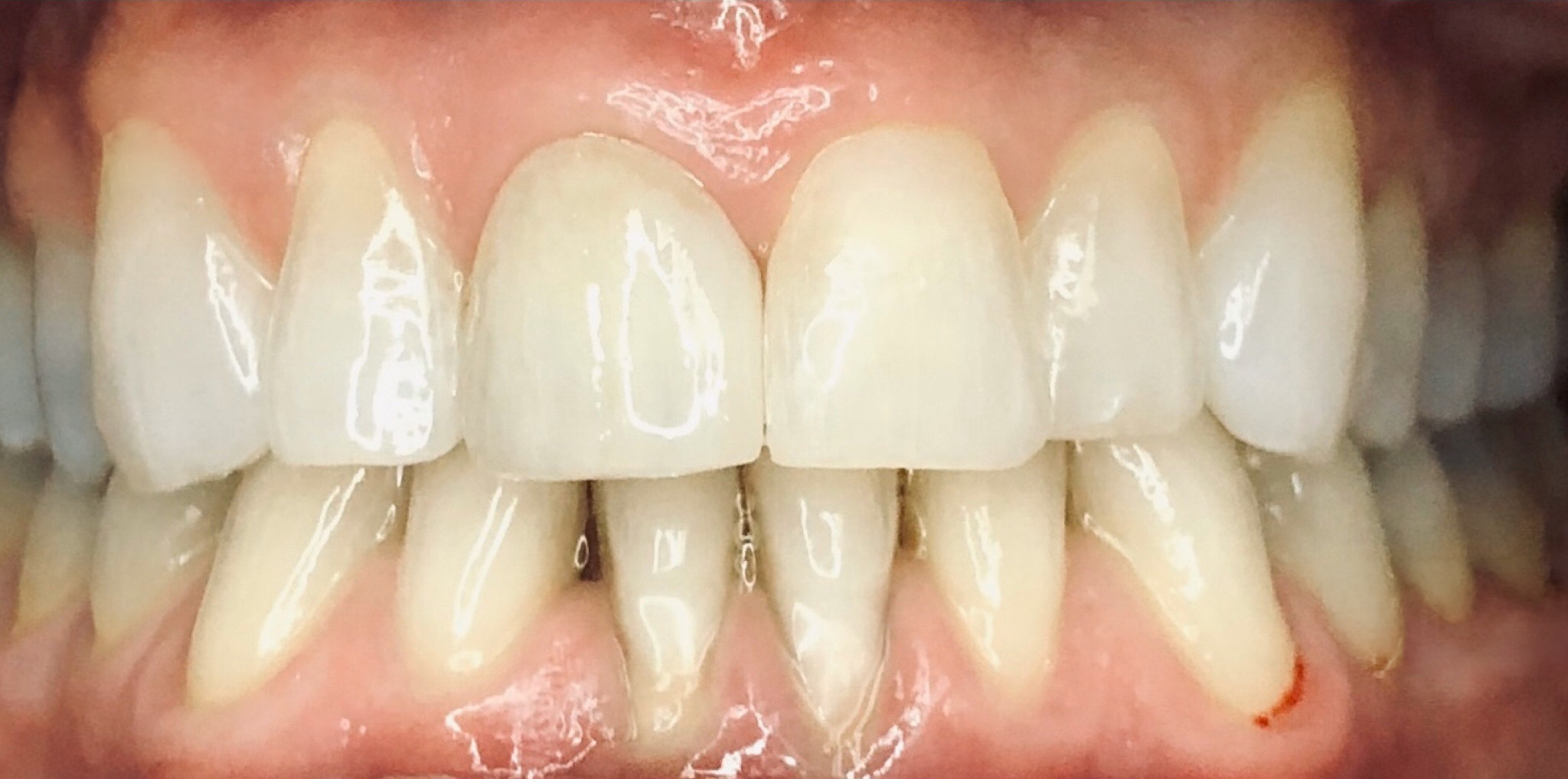 After: a single central crown replaced to match her surrounding teeth, Soquel Dental Office in Soquel, CA