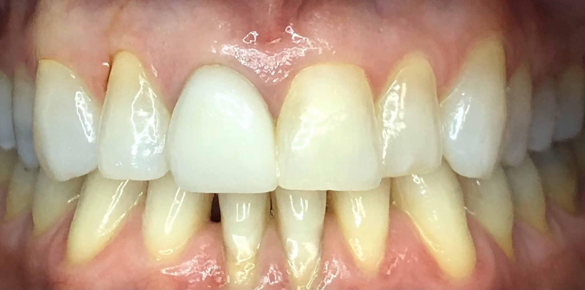Before: a single central crown replaced to match her surrounding teeth, Soquel Dental Office in Soquel, CA