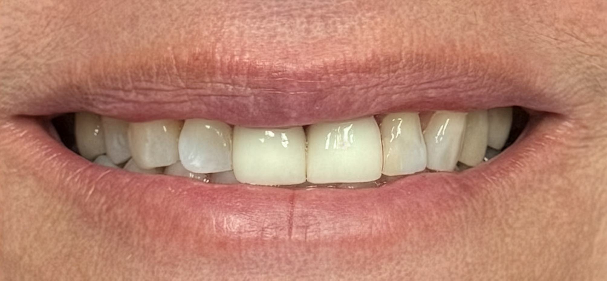 After: the two front teeth restored with EMAX crowns, Soquel Dental Office in Soquel, CA