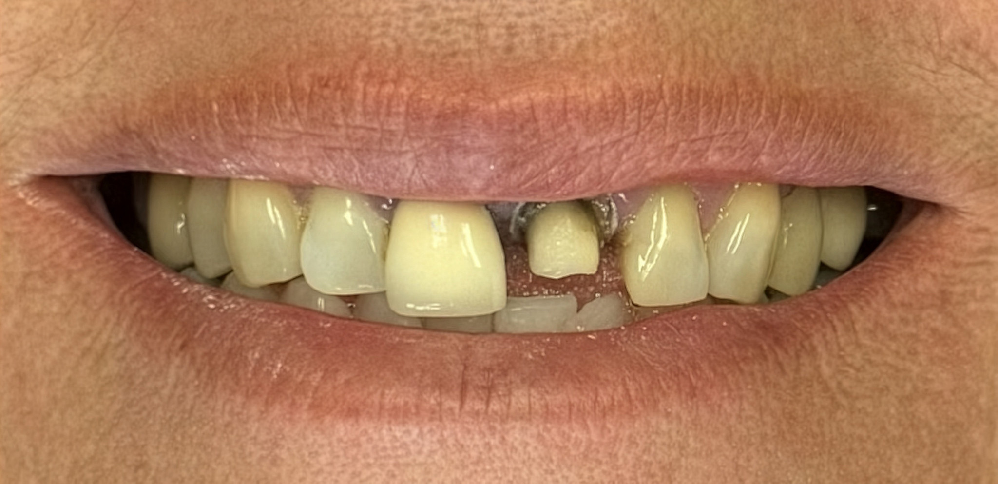 Before: the two front teeth restored with EMAX crowns, Soquel Dental Office in Soquel, CA